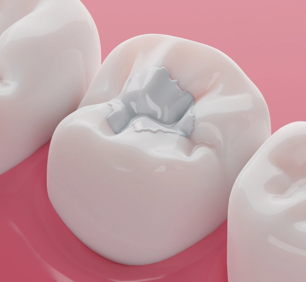 Repairing Decay With a Filling That Blends Into the Tooth