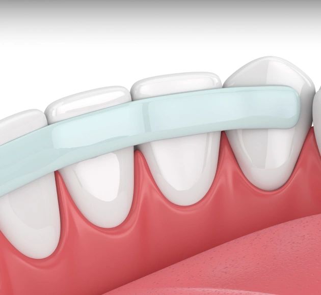 Same Day Cosmetic Repair Using Tooth Colored Resin