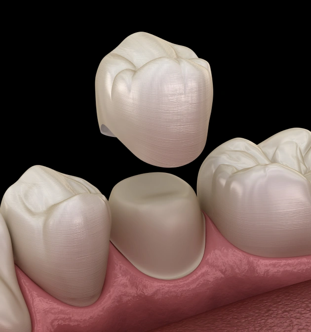 Full Coverage Restoration for Teeth That Need More Than a Filling