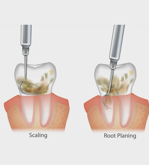 Deep Cleaning to Help Halt Periodontal Disease